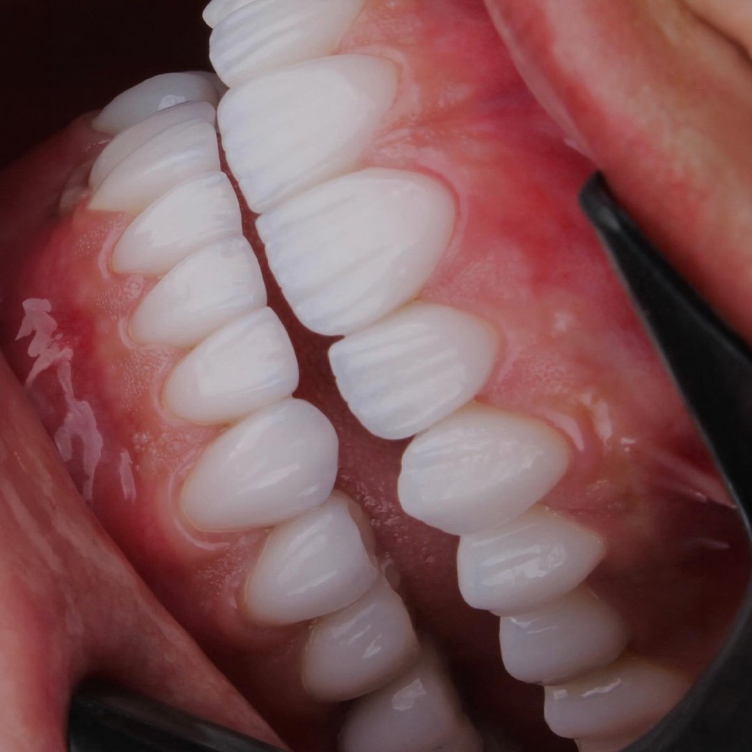 Detalhe de lente de porcelana produzida no laboratório do Dr. Guilherme Arantes