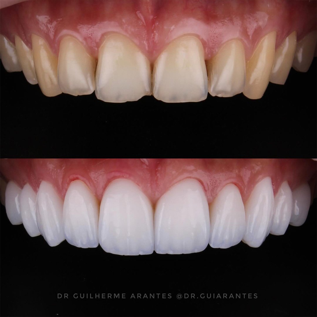 Resultado antes e depois de lentes de porcelana