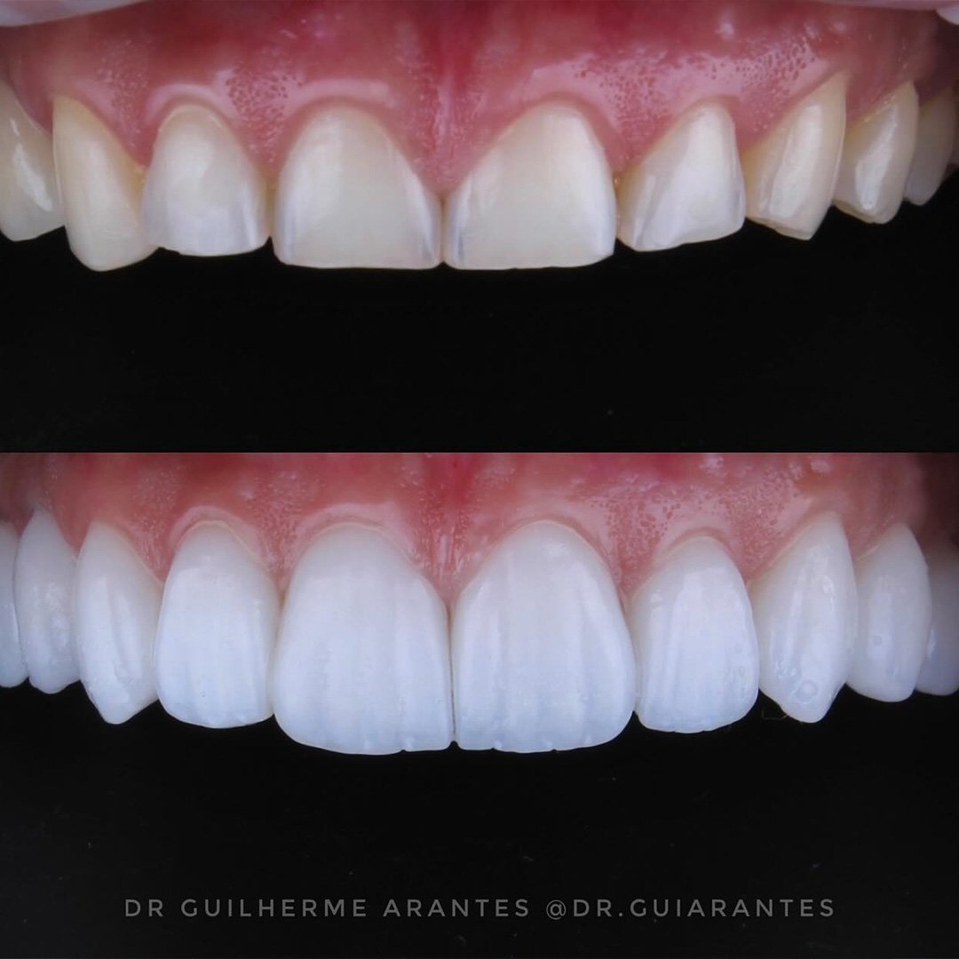 Resultado antes e depois de lentes de porcelana