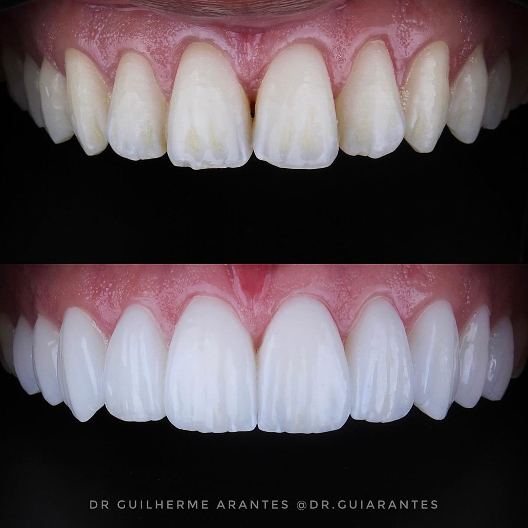 Resultado antes e depois de lentes de porcelana
