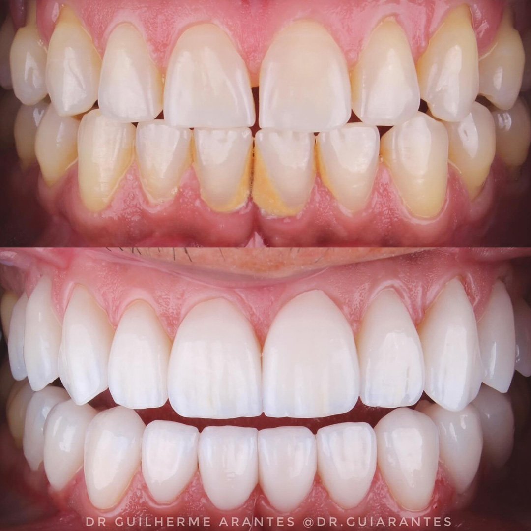 Resultado antes e depois de lentes de porcelana