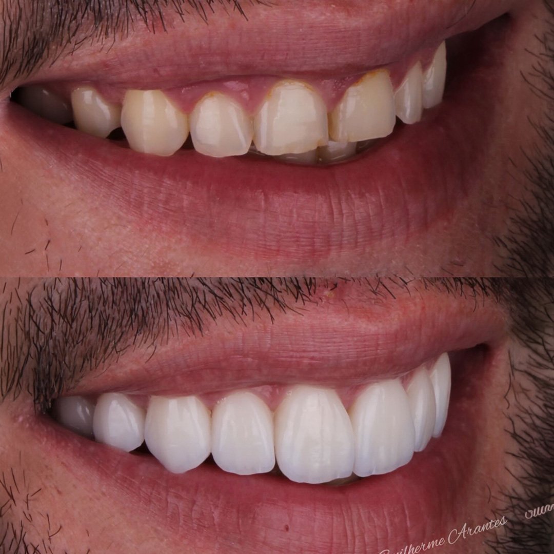 Resultado antes e depois de lentes de porcelana