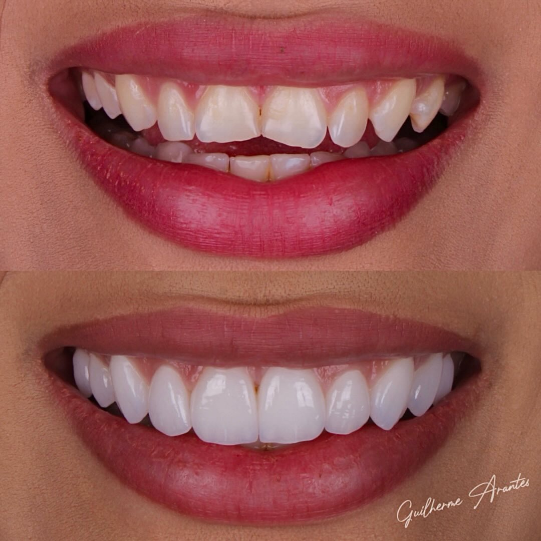 Resultado antes e depois de lentes de porcelana